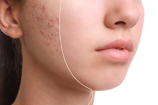Acne Products